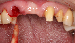 Extraction of Hopeless Tooth	